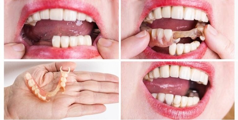 before-and-after-partial-dentures_1758640685